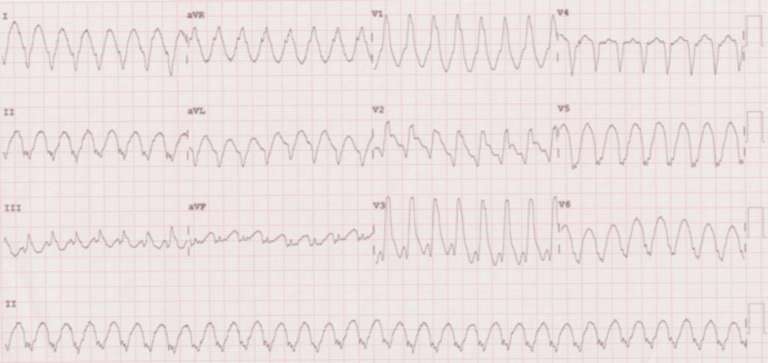 ECG e taquicardia ventricular características e laudos