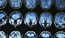 O que é Mal de Alzheimer?