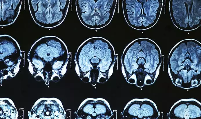 O que é Mal de Alzheimer?