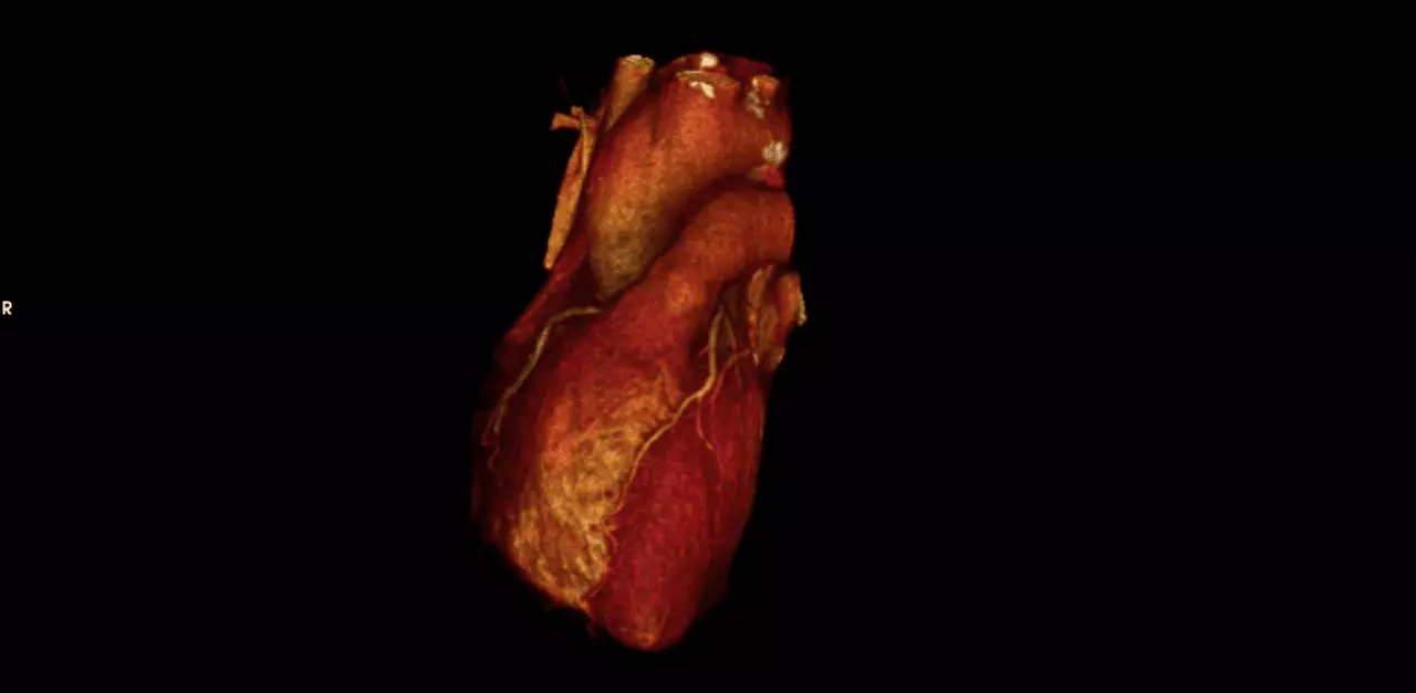 tomografia cardiovascular