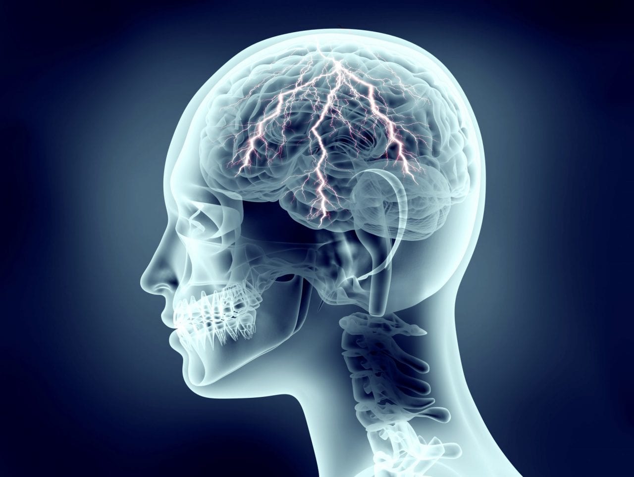 Eletroencefalograma com mapeamento cerebral Eletroencefalograma com mapeamento cerebral