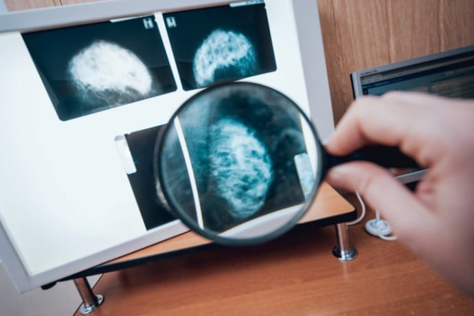 O que é telerradiologia e como ela pode contribuir no laudo de mamografia?