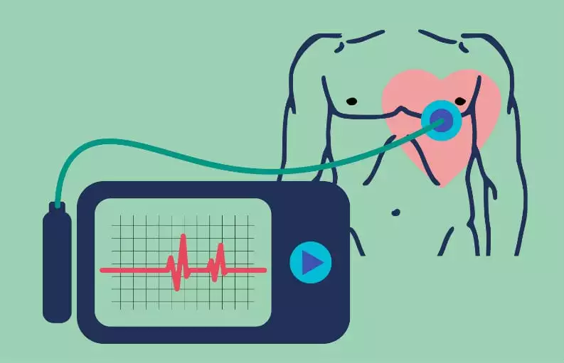 eletrocardiograma de longa duração eletrocardiograma de longa duração