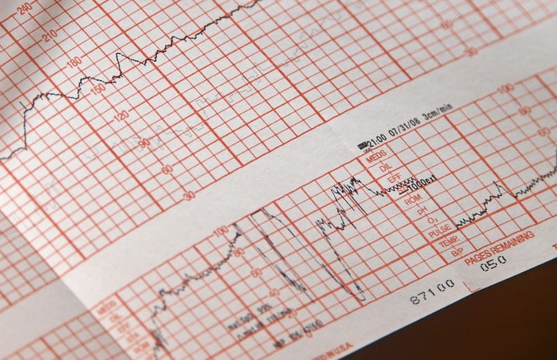 como ler um eletrocardiograma