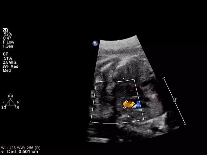 ecocardiograma-fetal-resultados.jpg
