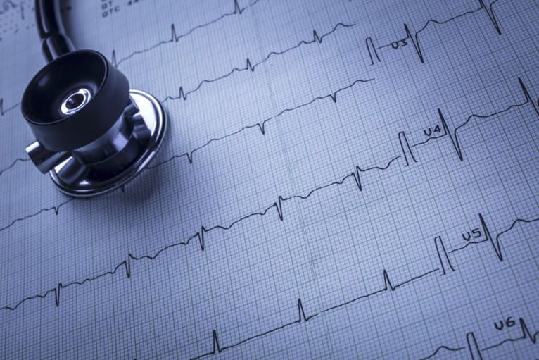 Traçado do eletrocardiograma: para que serve?