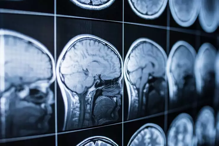 Qual a diferença entre morte encefálica e coma?