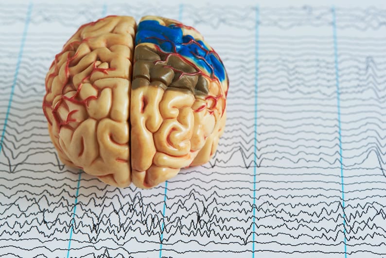 Eletroencefalograma na morte cerebral