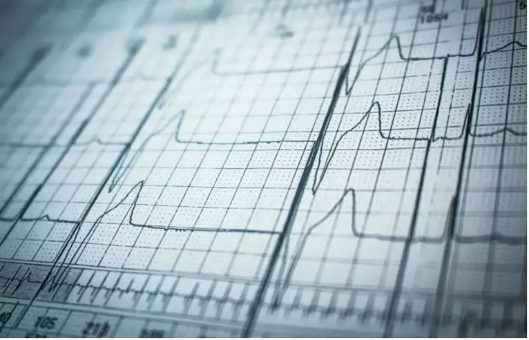 Holter cardíaco ou eletrocardiograma? O que é mais vantajoso?