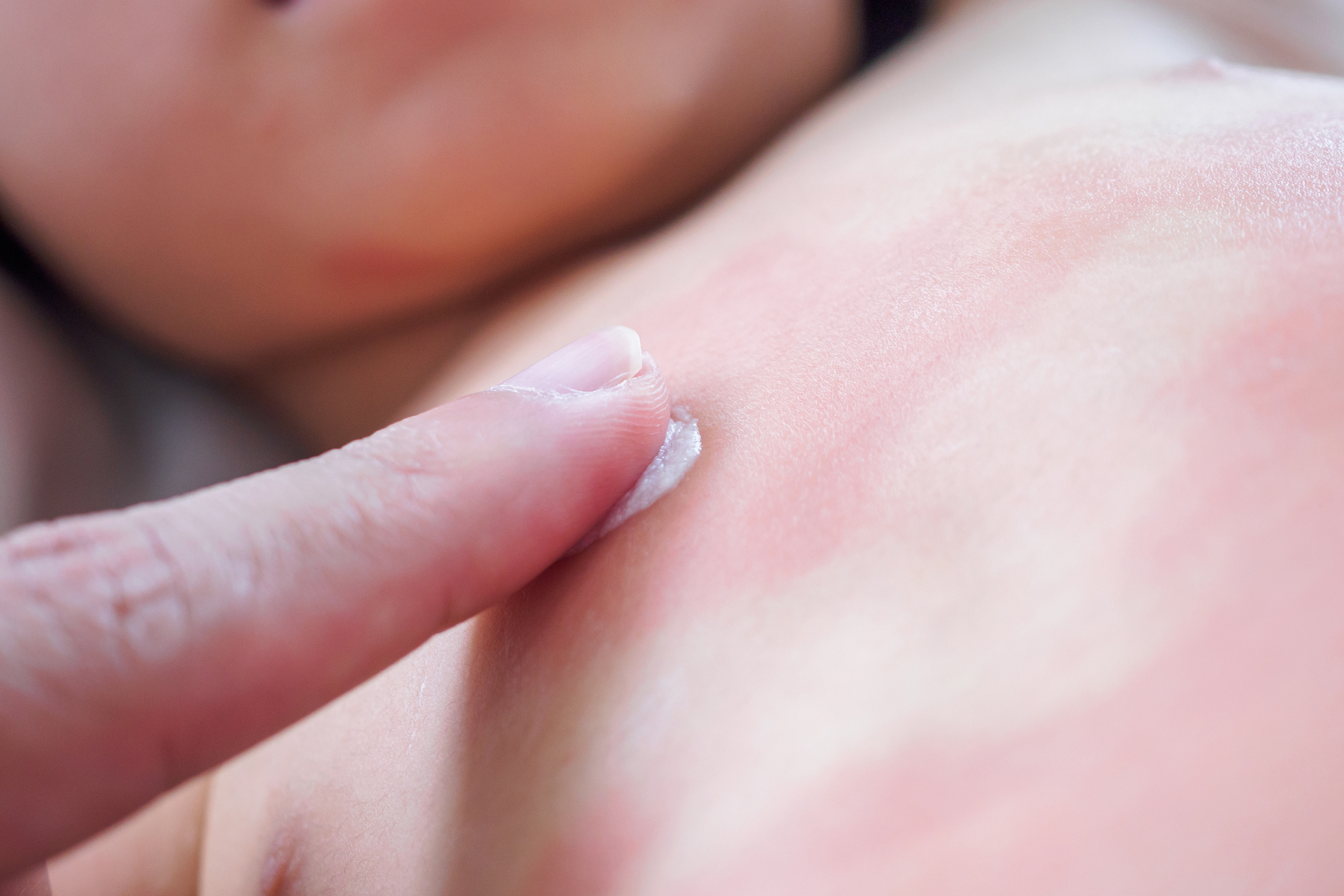 Dermatite atópica tem cura?