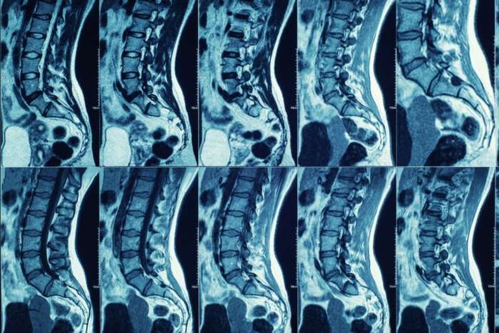 Ressonância magnética da coluna: saiba como é feita