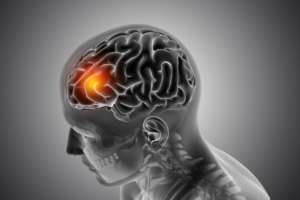 isquemia cerebral