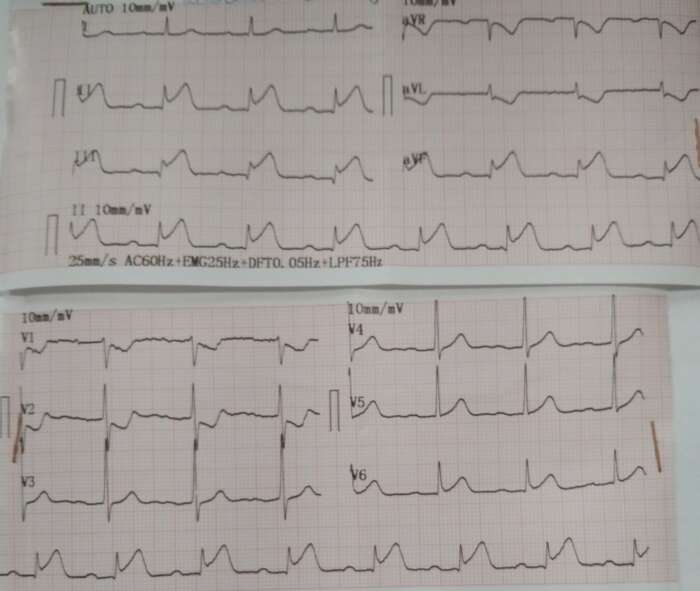 Infarto agudo do miocárdio em parede ínfero-lateral do ventrículo esquerdo.