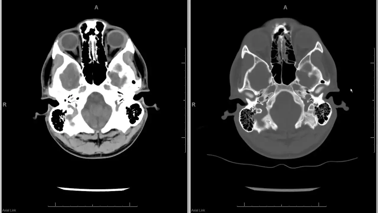 TC DE MANDIBULA • AMD Saúde