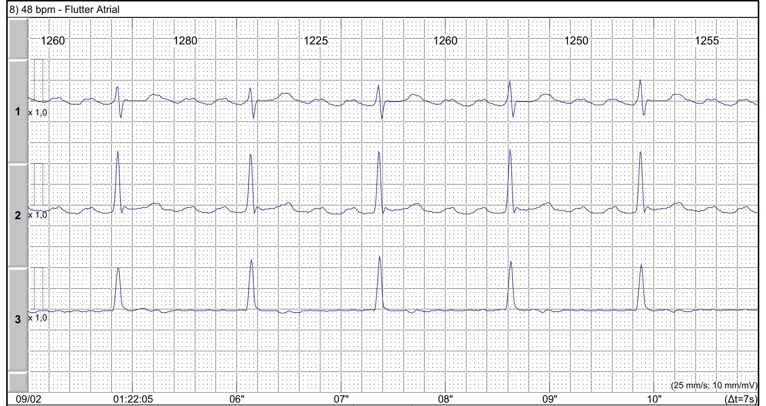 Flutter atrial com condução atrioventricular variável no Holter de ECG