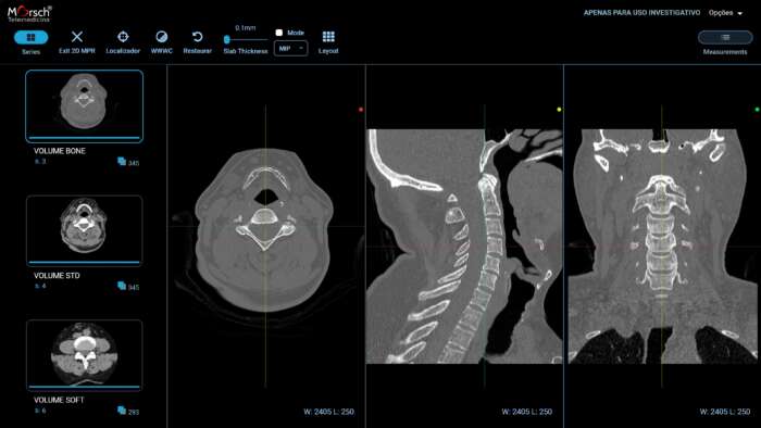 Corte tomográfico em 3D da coluna cervical