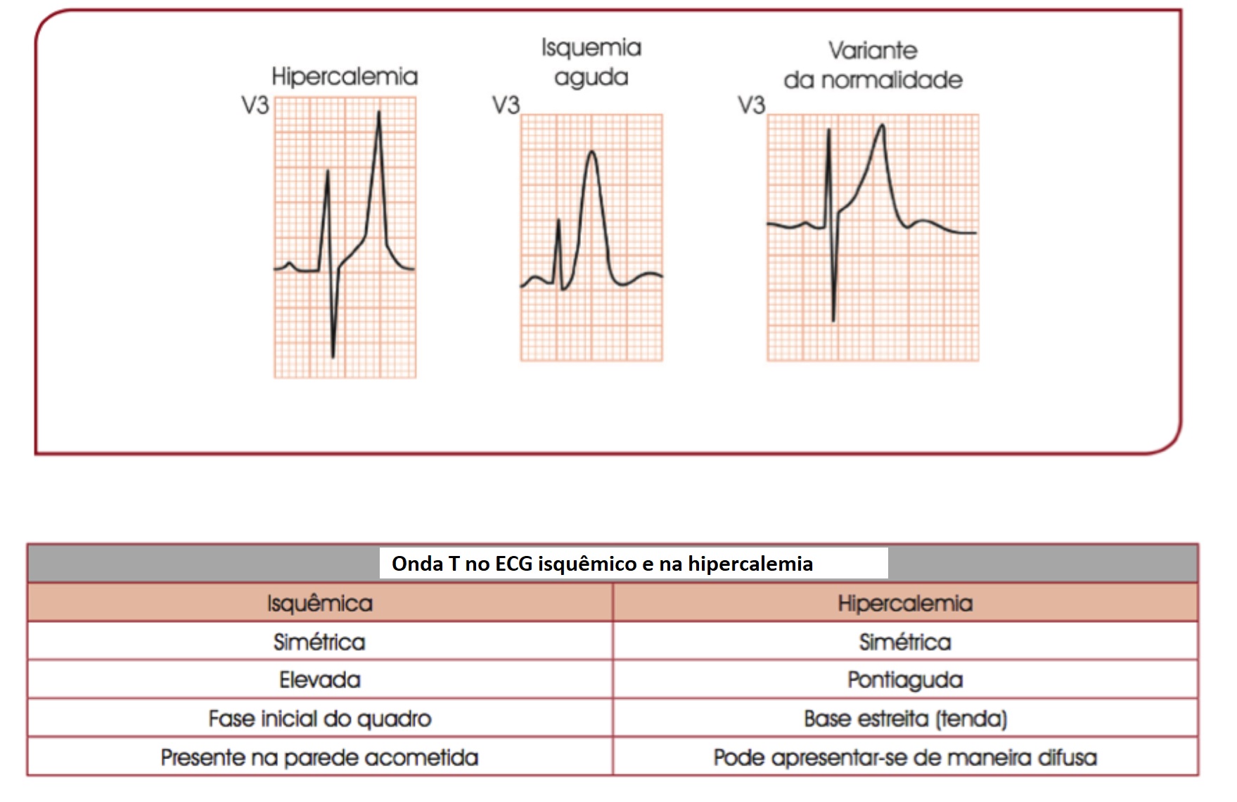 Hipercalemia No ECG Altera es No Exame E Diagn stico
