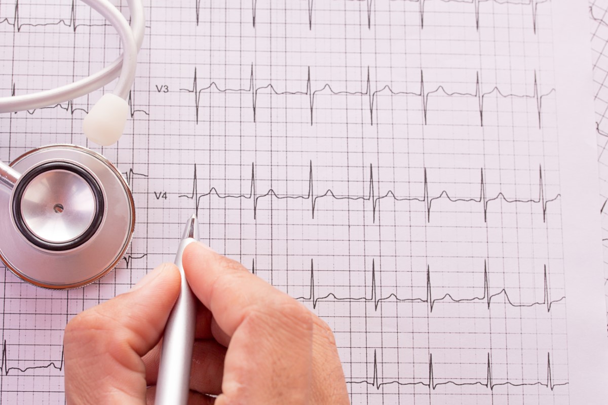 ECG normal avaliação 