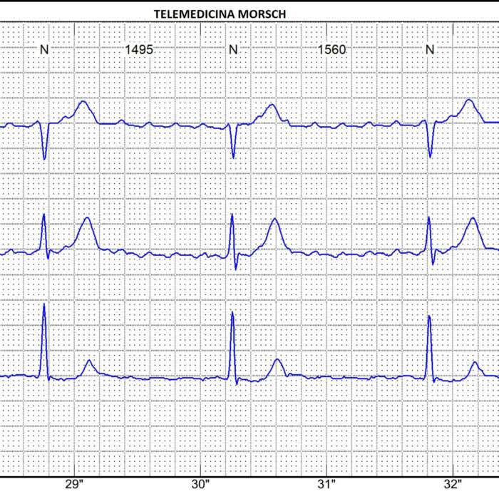 Observe no traçado de holter a onda P em forma de dente de serrote