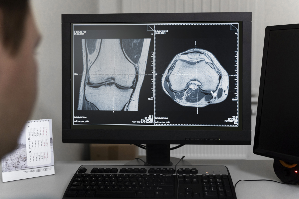 Avaliação a distância de osteoporose