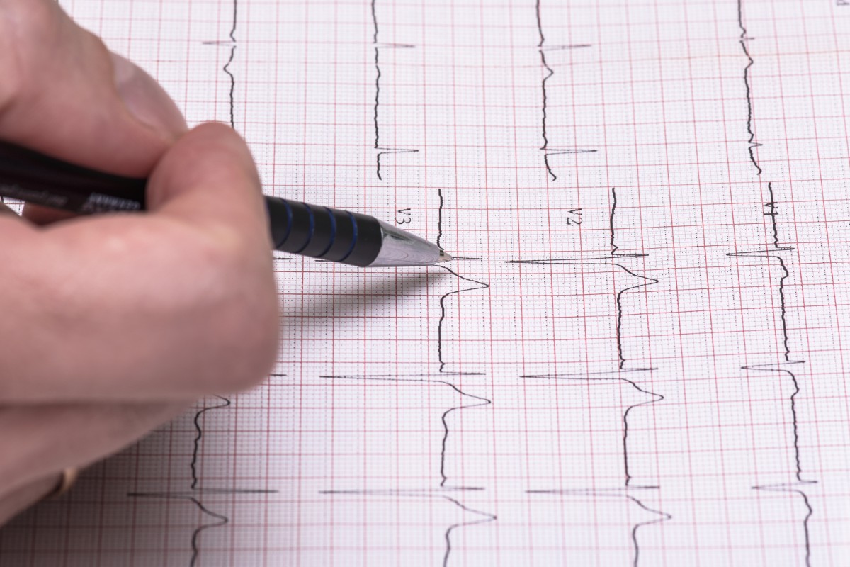 ECG ritmo juncional 